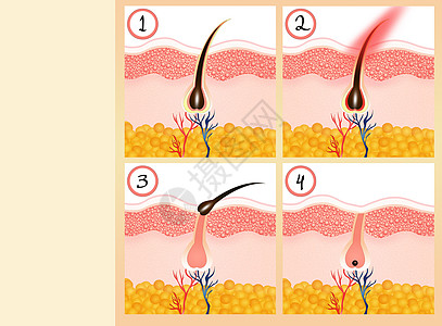 理发脱毛沙龙休息真皮美丽生长损失无毛头发插图乳突图片