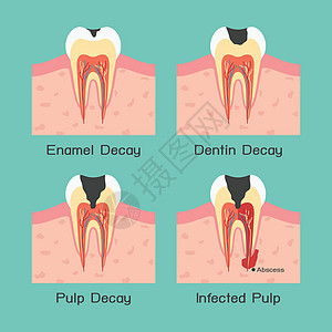 牙齿衰变图片