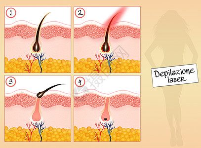 摘除头发理发无毛毛细管插图表皮生长卵泡脱毛皮肤科美丽损失图片