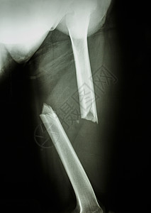 骨折大腿骨治疗医生辐射保健疼痛骨骼科学x射线药品电影图片