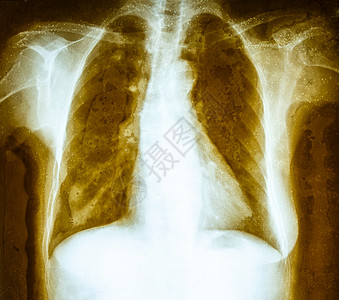 成人胸前X射线片身体疾病科学诊断药品胸部射线x射线放射科犯规图片