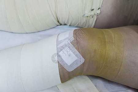 腿上的绷带事故骨科医疗扭伤身体拐杖治疗女性膝盖图片