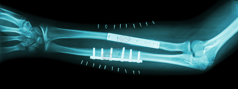 前臂骨折断耳纳尔和半径 由板块和螺丝操纵和内部固定x光假肢骨科外科治疗弯头x射线诊断医生电影图片