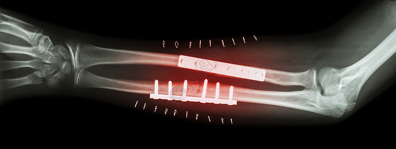 前臂骨折断耳纳尔和半径 由板块和螺丝操纵和内部固定疼痛医生病人诊断假肢x射线医院疾病扫描事故图片