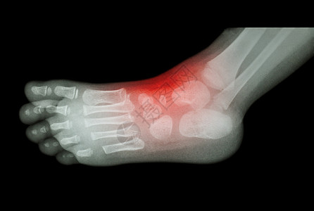 关节炎和脚踝受伤 儿童脚部X光片侧视横向骨科婴儿方阵脚跟风湿跗骨外科指骨手指痛风图片