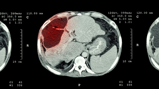 上腹部CT扫描 肝脏显示异常质量肝癌指针脊柱肝细胞调查电脑癌症器官电影保健医生图片