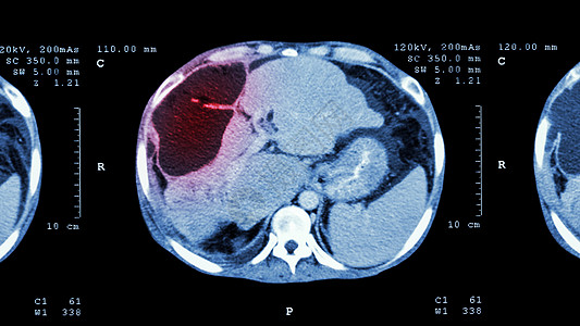 上腹部CT扫描 肝脏显示异常质量肝癌调查疾病医院蓝色标签放射科病人药品保健电影图片