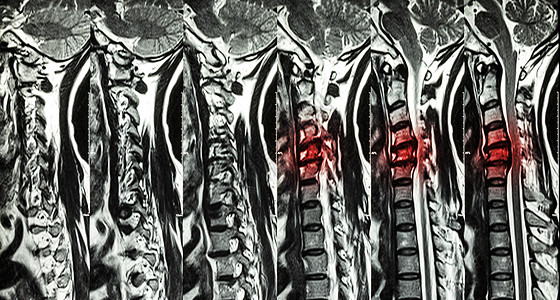 颈椎病伴椎间盘突出症 颈椎MRI 显示颈椎病伴椎间盘突出症压迫脊髓 脊髓病疾病调查放射科药品扫描脊椎绳索保健卫生医生背景图片