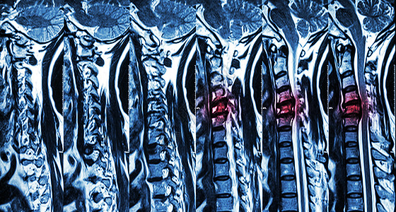 颈椎病伴椎间盘突出症 颈椎MRI 显示颈椎病伴椎间盘突出症压迫脊髓 脊髓病保健药品骨科压缩诊断骨骼x光蓝色x射线疾病背景图片