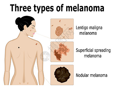 三种色素瘤图片