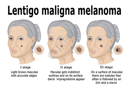 黑色素细胞伦蒂戈恶性黑皮瘤插画