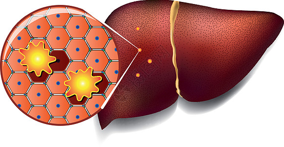 被毒素攻击的肝细胞身体肥胖卫生组织肝硬化排毒坏死癌症肠胃小叶图片