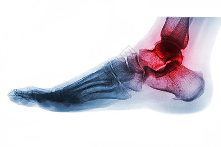 脚踝关节炎 脚部X光片 横向视图 反颜色风格疼痛疾病创伤x射线脚趾发炎跗骨扫描电影痛风图片