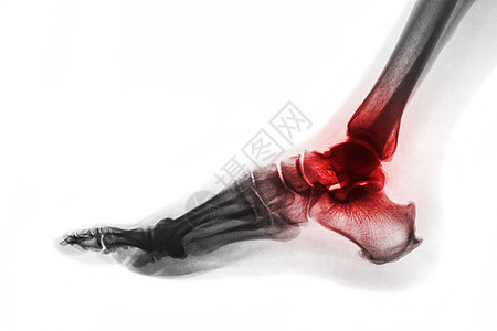 脚踝关节炎 足部X光片 横向视图 反向颜色风格 Gout 或风湿概念疼痛痛风跟骨病人扫描脚跟x射线扭伤射线跗骨图片