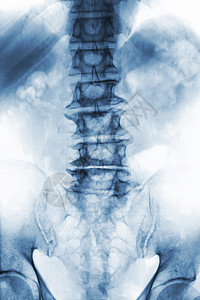 脊柱外科老年病人的薄膜X射线 lumbosacal脊椎显示骨质疏松 从降解过程中折断脊椎 Front View脊柱腰椎疾病解剖学疗法椎骨背景