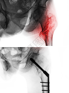 转子间骨折股骨 大腿骨 髋关节 X 光片以及手术前 上图 和手术后 下图 的比较 患者接受手术并插入髓内钉骨科扫描医生指甲治疗射图片