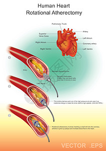 心形钻石血管成形术情况传动轴人心静脉流量金属支架脂肪心房不锈钢图片