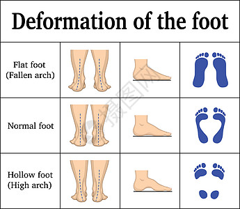 脚的变形图片