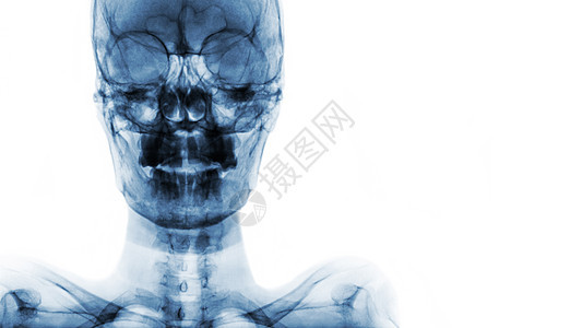 X射线胶片Skull AP 在右侧显示正常人的头骨和空白区域药品医生疾病病人射线骨骼x光保健x射线医院图片