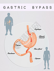 肠胃外科手术饮食卫生减肥保健肠子器官肥胖男性男人插图图片
