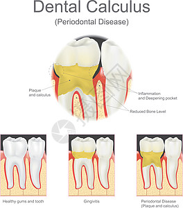 牙结石牙周病图片