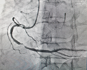 冠动脉疾病心脏病学心血管屏幕成人嫁接支架树干疼痛胸部药品图片