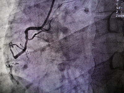 在右冠心动动脉处的STEMI图片