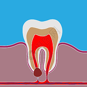口腔病的简单风格 有疼痛和炎症;牙齿根炎 牙根细胞 纸浆炎的医疗说明图片
