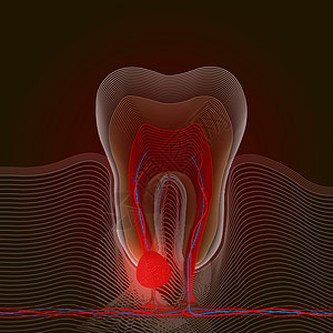 具有疼痛和发炎点的牙科疾病线性肾上腺化 牙根炎 牙根细胞病 软骨炎等医学说明 X光效果图片