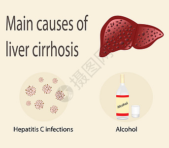 肝硬化的主要原因插图症状酒精预防卫生考试横幅肝硬化肝脏治疗图片