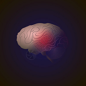 从真实到点的 x 射线效果的过渡 有痛点的脑部疾病 医学插图图片