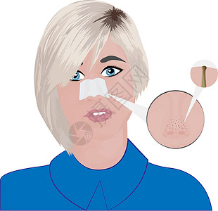 鼻子上的黑头人 治疗疙瘩奶油女士疾病温泉面具青少年卫生皮肤科粉刺图片