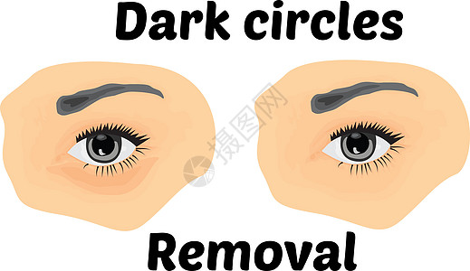 眼下黑暗的圆圈去除去治疗皮肤眼睛失眠症状治愈压力虚胖美容女性图片