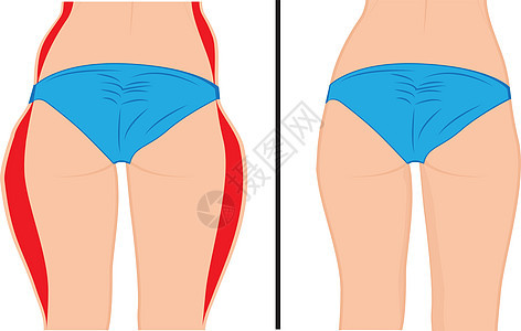 肥大腿矫正 抽脂术 之前和之后 它制作图案的女人身体矫正矢量手术肥胖外科营养女士锻炼脂肪重量腹部橘皮背景图片