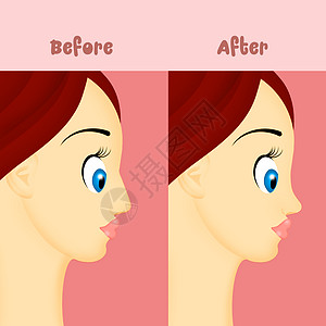之前和之后的犀利外科插图药品自尊干涉鼻孔女士美学手术程序背景图片