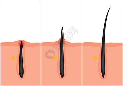 正常和向内生长的头发矢量图 护肤问题图片