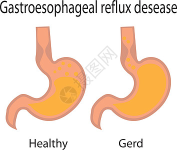 胃食管反流病 健康胃肠解剖学胃炎疾病食管症状气体图表卫生疼痛器官背景图片