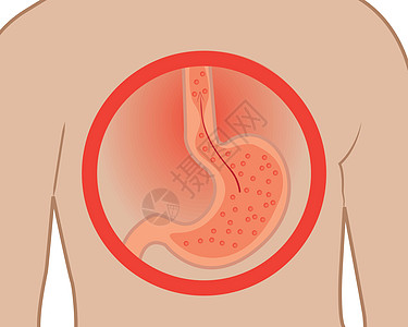 胃部在白色背景的人体病媒图解中心脏灼伤 腹部为白种背景下的人体矢量图片