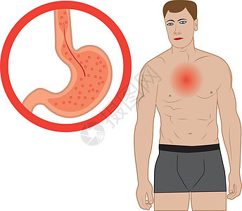 胃食管反流病 人体内的胃疼痛器官食管疾病气体解剖学科学胃炎烧伤括约肌背景图片