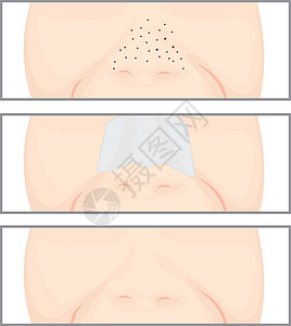 鼻子上的黑头护理面具温泉治疗皮肤缺陷毛孔疾病奶油女士图片