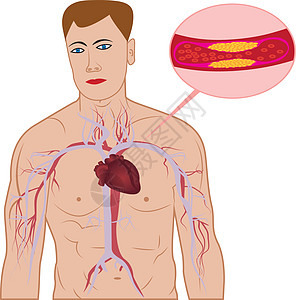 血管中胆固醇斑块的水平测试治疗疾病插图动脉粥样硬化心脏病攻击心脏牌匾诊断图片