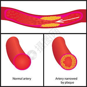 血管中胆固醇斑块的水平实验室控制封锁牌匾测试心血管验血风险医生疾病图片