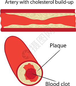 动脉中的胆固醇斑块图片