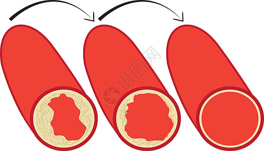 降低血管中胆固醇斑块的水平背景图片