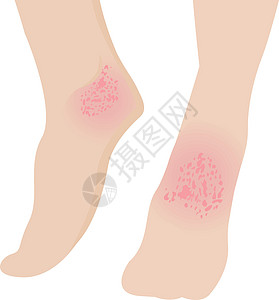 湿疹影响了脚皮肤科皮肤病图片
