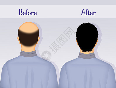 在理发移植前后和之后插图男性解决方案美学头发老化细胞症状男人治疗背景图片