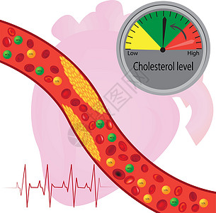 血管中的动脉粥样硬化斑块好和坏脂质背景图片