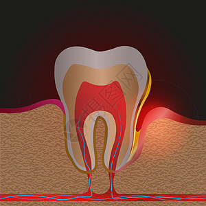 伴有疼痛和炎症的牙科疾病 牙根炎症牙龈疾病脓液在牙龈口袋斑块和牙结石中的医学说明 牙周炎牙周炎牙龈炎图片