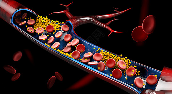 3d 用凝固胆固醇的立体积块显示血细胞风险解剖学牌匾积累身体保健危险脂类团体硬化图片