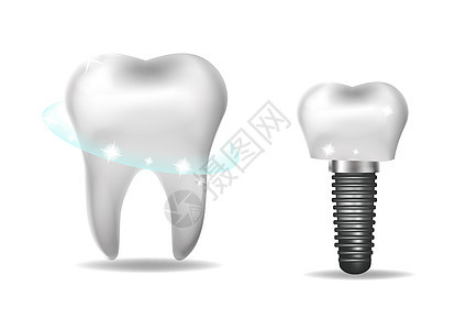 牙种植体假体 3D 逼真风格 牙科健康牙齿的概念 它制作图案矢量搪瓷原理图手术技术假肢治疗假体磨牙药品插图图片